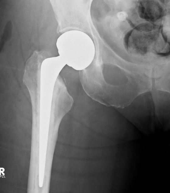 Modular Hemiarthroplasty